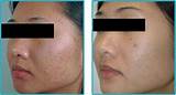 Pictures of Acne Scar Laser Treatment Uk