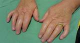 Psoriatic Arthritis Doctor Photos