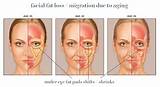 Photos of Side Effects Of Dermal Fillers Under Eyes