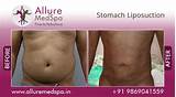 Belly Fat Laser Treatment Cost Pictures