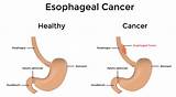 Photos of Mayo Clinic Esophageal Cancer