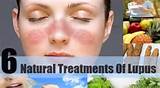 Lupus Home Remedies Treatments Pictures