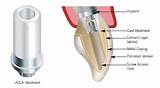 Innova Dental Implants Images
