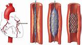 Stent Medical Definition Photos