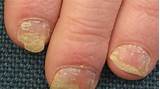 Pictures of Nail Pitting Treatment