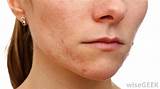 Pcos And Acne Treatment Pictures