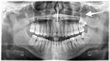Photos of How Much Is A Dental X Ray Without Insurance