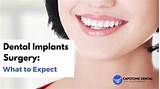 Photos of Permanent Dental Implants Procedure