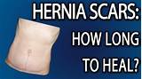 Images of What Is The Recovery Time For Abdominal Hernia Surgery