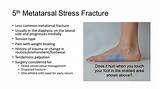 Pelvic Stress Fracture Recovery Images