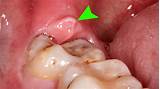 Treatment For Dry Socket After Tooth Removal