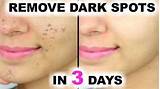 Pimple Spot Removal Images