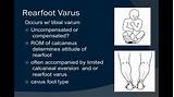 Images of Rearfoot Varus Treatment