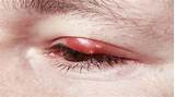 Eyelid Stye Medication Images