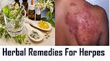 Pictures of Herpes Home Remedies Cure