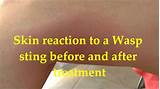 Reaction To Bee Sting Treatment Images