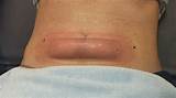 Pictures of Belly Fat Laser Treatment Cost