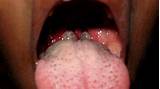 Acid Reflux Sore Throat Treatment Pictures
