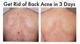 Photos of Best Treatment For Bacne Scars