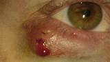 Conjunctival Pyogenic Granuloma Treatment Images