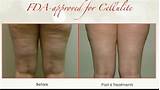 Velashape Cellulite Treatment