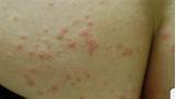 Pictures of Home Remedies Fungal Rash