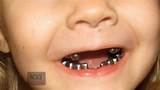 Silver Caps On Kids Teeth