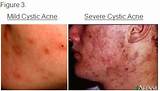 Pictures of Cystic Acne Under Skin Treatment