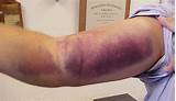 Images of Bicep Tendon Surgery Recovery