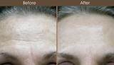 Photos of Laser Skin Treatment Nyc