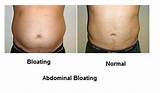 Photos of Excessive Gas Bloating Weight Gain
