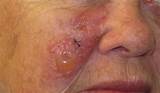 Photos of Severe Allergic Skin Reaction Treatment