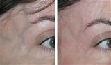 Spider Vein Laser Treatment How Long To See Results Images