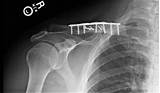 Recovery After Collarbone Surgery Images
