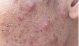 Best Home Treatment For Cystic Acne