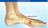 Avulsion Fracture Foot Treatment Photos