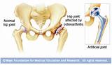 Pictures of Partial Hip Replacement Recovery Time Elderly