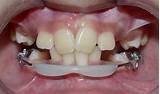 Pictures of Orthodontic Bumper