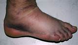 Images of Swollen Ankle Sprain Treatment