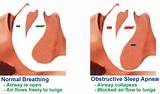 Severe Obstructive Sleep Apnea Treatment Images