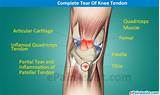 Knee Tendonitis Recovery Images