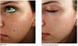 Photos of Dermapen Micro Needling Treatment Of Acne Scars
