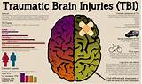Mild Traumatic Brain Injury Settlements Images