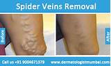Latest Treatment For Spider Veins Pictures
