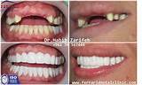 Prices For Veneers