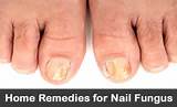 Pictures of Fingernails Fungus Home Remedies