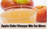 Photos of Shingles Home Remedies Apple Cider Vinegar