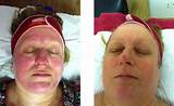 Light Therapy For Rosacea Pictures