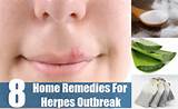 Herpes Home Remedies Cure Photos