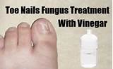 Vinegar Home Remedies For Toe Fungus Images